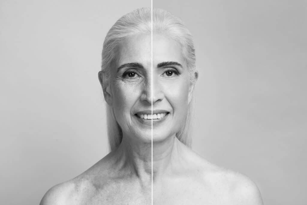 image avant après le traitement anti-âge du visage et du cou par Hifu expert lifting